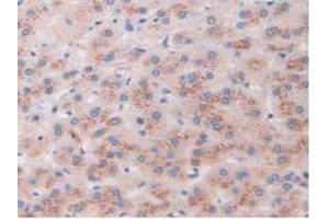 IHC-P analysis of Human Liver Cancer Tissue, with DAB staining. (AKAP11 Antikörper  (AA 1650-1901))