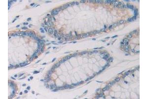 DAB staining on IHC-P; Samples: Human Colorectal cancer Tissue (Ribonuclease A10 (AA 27-216) Antikörper)