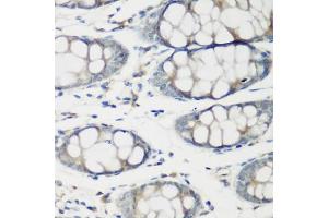 Immunohistochemistry of paraffin-embedded human colon using TNNC2 antibody (ABIN6129604, ABIN6149353, ABIN6149354 and ABIN6223680) at dilution of 1:200 (40x lens). (TNNC2 Antikörper  (AA 1-160))