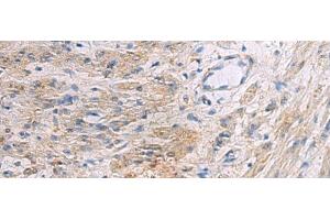 Immunohistochemistry of paraffin-embedded Human gastric cancer tissue using SLC30A3 Polyclonal Antibody at dilution of 1:55(x200) (Slc30a3 Antikörper)