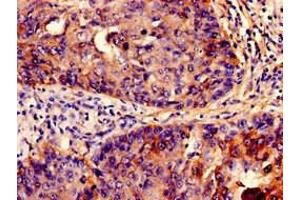 Immunohistochemistry analysis of human cervical cancer using ABIN7156687 at dilution of 1:100 (IFITM3 Antikörper  (AA 1-57))
