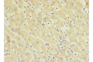 Immunohistochemistry of paraffin-embedded human liver cancer using ABIN7173293 at dilution of 1:100 (TMEM91 Antikörper  (AA 1-97))