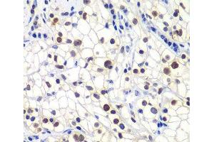 Immunohistochemistry of paraffin-embedded Human kidney cancer using GTF2F2 Polyclonal Antibody at dilution of 1:200 (40x lens).