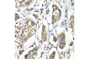 Immunohistochemistry of paraffin-embedded human liver cancer using NFS1 antibody. (NFS1 Antikörper)