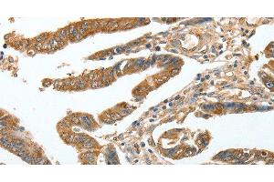 Immunohistochemistry of paraffin-embedded Human colon cancer tissue using CKAP2 Polyclonal Antibody at dilution 1:70 (CKAP2 Antikörper)