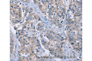 Immunohistochemistry of Human breast cancer using KCNQ5 Polyclonal Antibody at dilution of 1:30 (KCNQ5 Antikörper)