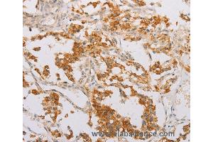 Immunohistochemistry of Human lung cancer using STK40 Polyclonal Antibody at dilution of 1:40 (STK40 Antikörper)