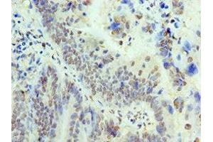 Immunohistochemistry of paraffin-embedded human colon cancer using ABIN7172050 at dilution of 1:100 (THOC1 Antikörper  (AA 428-657))