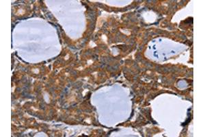 The image on the left is immunohistochemistry of paraffin-embedded Human thyroid cancer tissue using ABIN7130635(PITPNM1 Antibody) at dilution 1/40, on the right is treated with fusion protein. (PITPNM1 Antikörper)