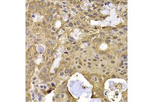 Immunohistochemistry of paraffin-embedded human oophoroma using NAA20 antibody (ABIN5974272) at dilution of 1/100 (40x lens). (NAT5 Antikörper)