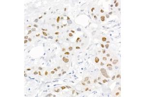 Immunohistochemistry of paraffin-embedded human breast cancer using Phospho-c-Jun-S73 Rabbit pAb (ABIN3023567, ABIN3023568, ABIN3023569 and ABIN6225411) at dilution of 1:25 (40x lens). (C-JUN Antikörper  (pSer73))