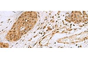 Immunohistochemistry of paraffin-embedded Human esophagus cancer tissue using NVL Polyclonal Antibody at dilution of 1:80(x200) (NVL Antikörper)