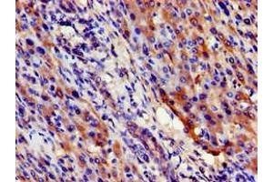 Immunohistochemistry of paraffin-embedded human liver cancer using ABIN7169599 at dilution of 1:100 (SIGMAR1 Antikörper  (AA 112-169))