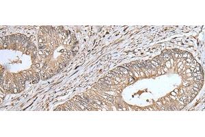 Immunohistochemistry of paraffin-embedded Human colorectal cancer tissue using UQCRQ Polyclonal Antibody at dilution of 1:45(x200) (UQCRQ Antikörper)