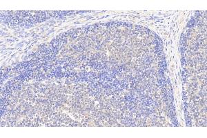 Detection of G6PD in Human Lymph node Tissue using Polyclonal Antibody to Glucose-6-phosphate Dehydrogenase (G6PD) (Glucose-6-Phosphate Dehydrogenase Antikörper)