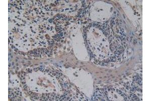 IHC-P analysis of Human Skin Cancer Tissue, with DAB staining. (NFkB Antikörper  (AA 805-892))