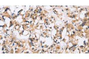 Immunohistochemistry of paraffin-embedded Human thyroid cancer using CKMT2 Polyclonal Antibody at dilution of 1:60 (CKMT2 Antikörper)