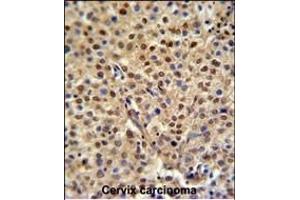 C19orf21 Antibody (N-term) (ABIN651044 and ABIN2840046) IHC analysis in formalin fixed and paraffin embedded human cervix carcinoma followed by peroxidase conjugation of the secondary antibody and DAB staining. (C19orf21 Antikörper  (N-Term))