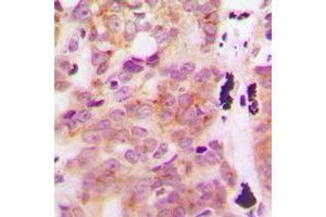 Immunohistochemical analysis of GLB1L3 staining in human breast cancer formalin fixed paraffin embedded tissue section. (GLB1L3 Antikörper  (Center))