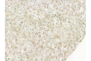 ABIN6264887 and ABIN6276947 at 1/100 staining human astrocytoma by IHC-P. (RUVBL2 Antikörper  (Internal Region))