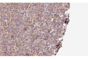 ABIN6273195 at 1/100 staining Human lymph cancer tissue by IHC-P. (SLC10A2 Antikörper  (C-Term))