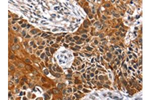 The image on the left is immunohistochemistry of paraffin-embedded Human esophagus cancer tissue using ABIN7129727(HOXB1 Antibody) at dilution 1/40, on the right is treated with fusion protein. (HOXB1 Antikörper)