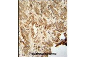 NAT14 antibody (N-term) (ABIN654245 and ABIN2844071) immunohistochemistry analysis in formalin fixed and paraffin embedded human hepatocarcinoma followed by peroxidase conjugation of the secondary antibody and DAB staining. (NAT14 Antikörper  (N-Term))