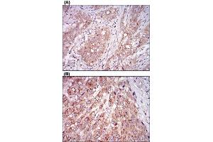 Immunohistochemical staining of human cervical cancer tissues (A) and liver cancer tissues (B) with MSTN monoclonal antibody, clone 6E4E6  at 1:200-1:1000 dilution.
