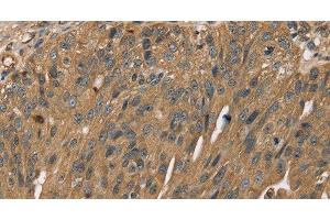 Immunohistochemistry of paraffin-embedded Human breast cancer using SCGB2A1 Polyclonal Antibody at dilution of 1:50 (SCGB2A1 Antikörper)