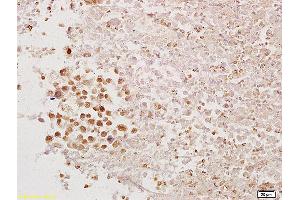Formalin-fixed and paraffin embedded mouse tumor tissue labeled with Anti-PAX1 Polyclonal Antibody, Unconjugated (ABIN673269) at 1:200 followed by conjugation to the secondary antibody and DAB staining.