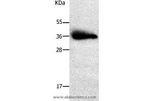 Western blot analysis of Human liver cancer tissue, using PPAP2A Polyclonal Antibody at dilution of 1:650 (PLPP1 Antikörper)