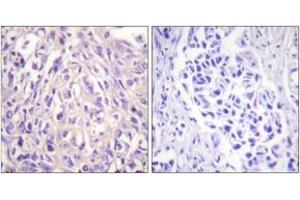 Immunohistochemistry analysis of paraffin-embedded human breast carcinoma tissue, using UBE1L Antibody. (UBA7 Antikörper  (AA 963-1012))
