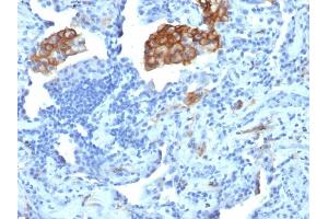 Formalin-fixed, paraffin-embedded human Lung Carcinoma stained with CD209 Mouse Monoclonal Antibody (C209/1781). (DC-SIGN/CD209 Antikörper)