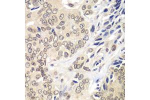 Immunohistochemistry of paraffin-embedded human prostate cancer using RNF2 antibody. (RNF2 Antikörper  (AA 1-336))