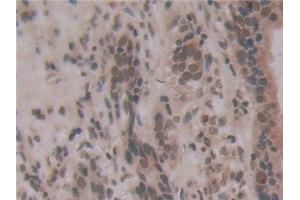 Detection of ENPP2 in Human Stomach cancer Tissue using Monoclonal Antibody to Ectonucleotide Pyrophosphatase/Phosphodiesterase 2 (ENPP2) (ENPP2 Antikörper  (AA 637-905))