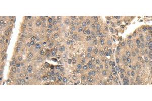 Immunohistochemistry of paraffin-embedded Human liver cancer using TXN Polyclonal Antibody at dilution of 1:40 (TXN Antikörper)