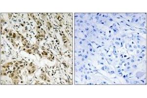 Immunohistochemistry analysis of paraffin-embedded human breast carcinoma tissue, using CtBP1 (Ab-422) Antibody. (CTBP1 Antikörper  (AA 388-437))