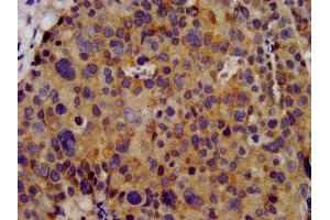 IHC image of ABIN7163969 diluted at 1:300 and staining in paraffin-embedded human pancreatic cancer performed on a Leica BondTM system. (KCNC3 Antikörper  (AA 638-745))