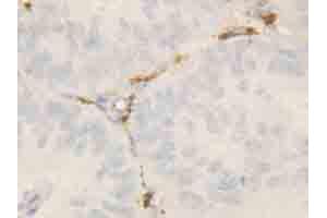 Immunohistochemical staining of ROCK2 on formalin fixed, paraffin embedded human intestinal cancer with ROCK2 polyclonal antibody . (ROCK2 Antikörper  (N-Term))