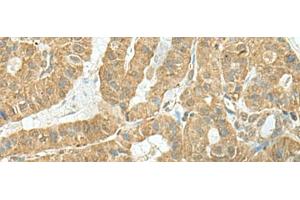 Immunohistochemistry of paraffin-embedded Human thyroid cancer tissue using TENT5C Polyclonal Antibody at dilution of 1:110(x200) (FAM46C Antikörper)