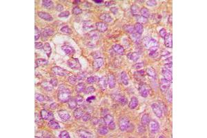 Immunohistochemical analysis of IKK beta (pY188) staining in human breast cancer formalin fixed paraffin embedded tissue section. (IKBKB Antikörper  (pTyr188))