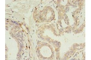 Immunohistochemistry of paraffin-embedded human breast cancer using ABIN7167192 at dilution of 1:100