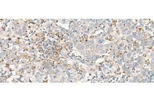 Immunohistochemistry of paraffin-embedded Human cervical cancer tissue using SLC41A3 Polyclonal Antibody at dilution of 1:35(x200) (SLC41A3 Antikörper)