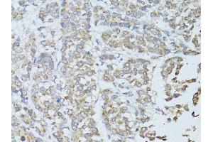 Immunohistochemistry of paraffin-embedded human colon carcinoma using TEFM antibody (ABIN5974873) at dilution of 1/100 (40x lens). (TEFM Antikörper)