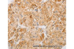 Immunohistochemistry of Human liver cancer using NGF Polyclonal Antibody at dilution of 1:40 (Nerve Growth Factor Antikörper)