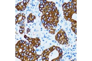 Immunohistochemistry of paraffin-embedded human gastric cancer using CTSE antibody. (Cathepsin E Antikörper)
