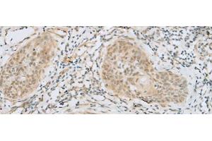 Immunohistochemistry of paraffin-embedded Human esophagus cancer tissue using HELT Polyclonal Antibody at dilution of 1:40(x200) (HELT Antikörper)