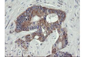 Immunohistochemical staining of paraffin-embedded Adenocarcinoma of Human colon tissue using anti-VBP1 mouse monoclonal antibody. (VBP1 Antikörper)