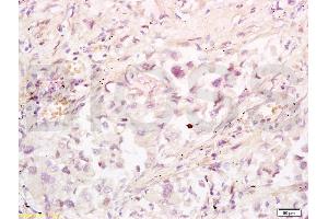Formalin-fixed and paraffin embedded human lung carcinoma tissue labeled with Anti-RRM1 Polyclonal Antibody, Unconjugated (ABIN731543) at 1:200 followed by conjugation to the secondary antibody, (SP-0023), and DAB staining (RRM1 Antikörper  (AA 733-778))