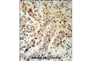KRT13 Antibody (N-term) (R) IHC analysis in formalin fixed and paraffin embedded human breast carcinoma followed by peroxidase conjugation of the secondary antibody and DAB staining.